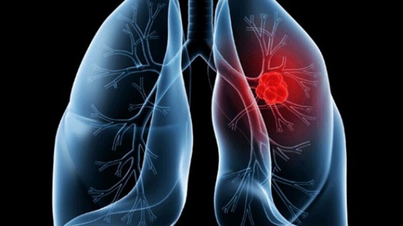 Adenocarcinoma pulmonar: entenda o câncer retirado do papa Leão