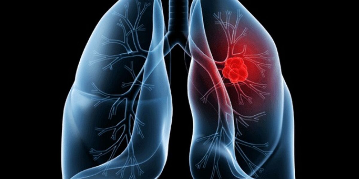 Adenocarcinoma pulmonar: entenda o câncer retirado do papa Leão